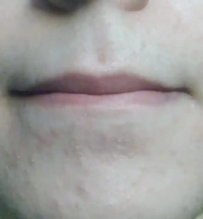 Dudak Kenarında Kızarıklık: Nedenleri, Korunma ve Etkili Tedavi Yöntemleri