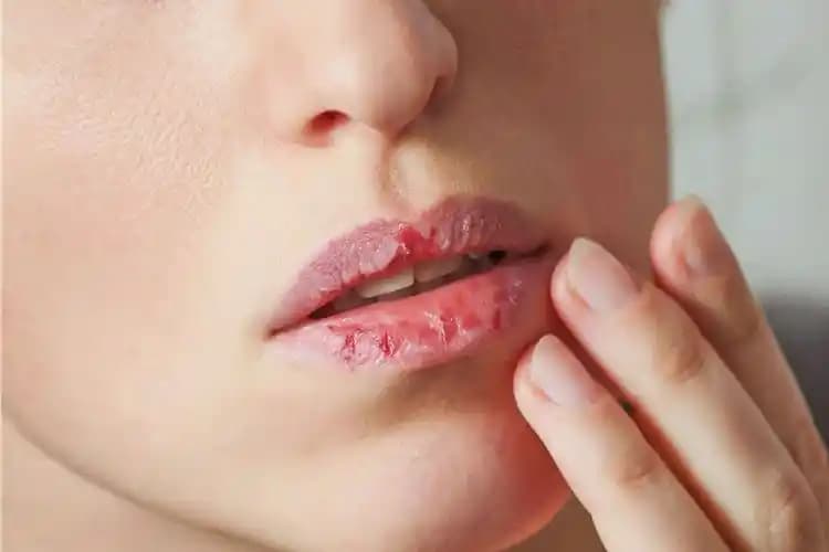 Dudak Yarasına İyi Gelen Merhemler ve Etkili Bakım Yöntemleri Rehberi