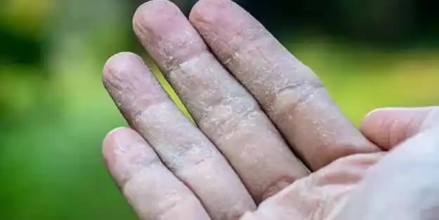 El Kuruluğu: Nedenleri, Belirtileri ve Etkili Bakım Yöntemleri Hakkında Bilgi