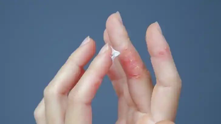 El Kuruması Nedenleri ve Etkili Çözüm Yolları: Cilt Sağlığınızı Korumak İçin Öneriler