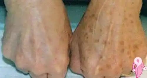 El Üstündeki Kahverengi Lekeler: Nedenleri, Tedavi Yöntemleri ve Korunma Önerileri