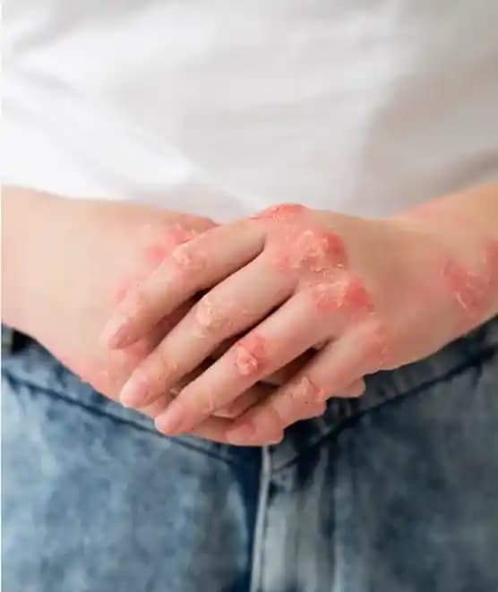 Elde Sulu Egzama Nedenleri, Belirtileri ve Etkili Bakım Yöntemleri Rehberi