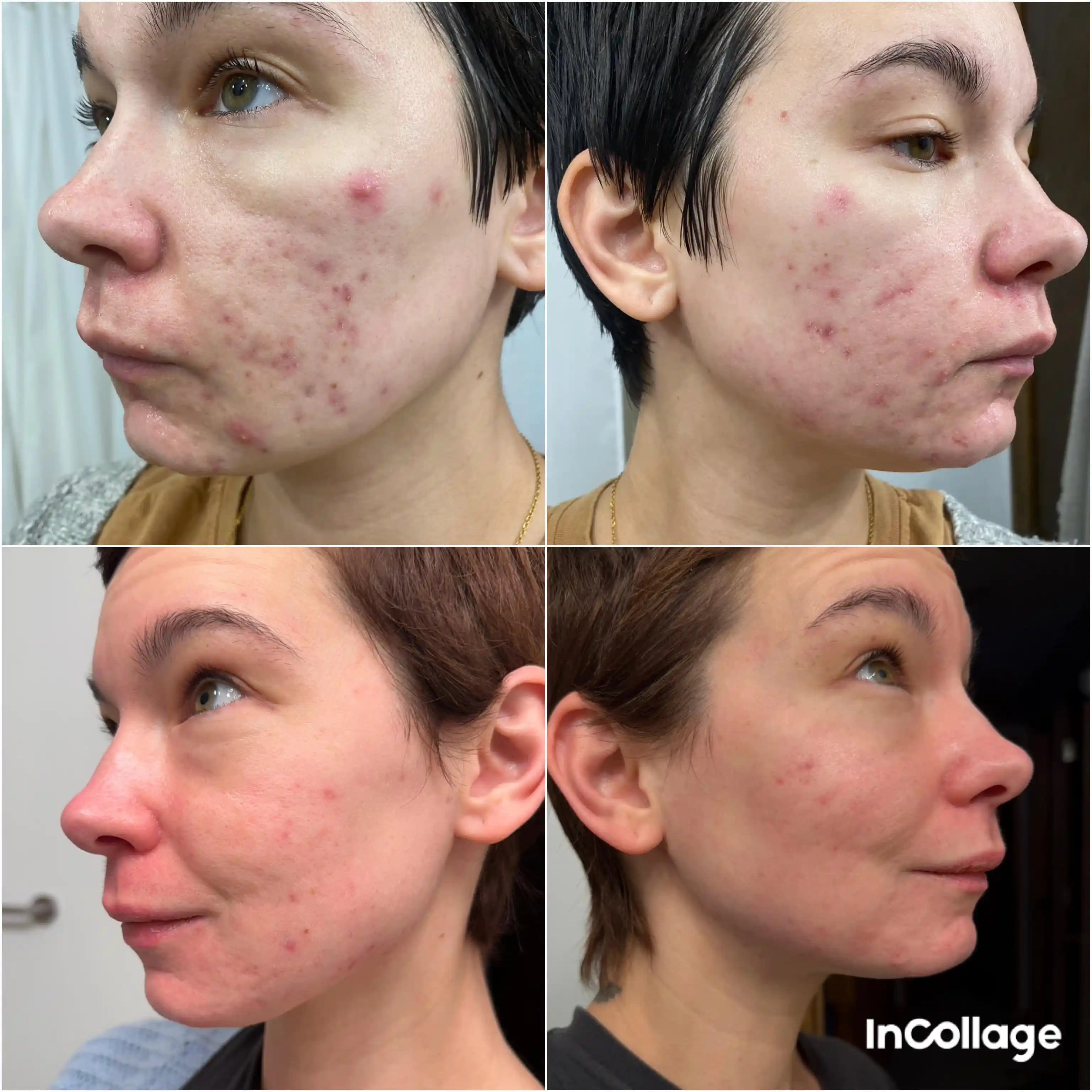 Accutane Tedavisi: Şiddetli Akne İçin Etkili ve Dikkat Gerektiren Bir Yöntem