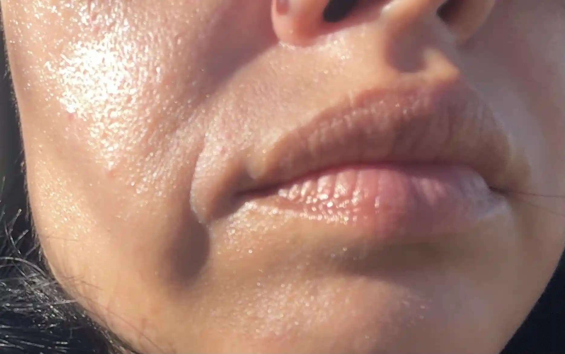 Ağız Köşesindeki Ani Derin Kırışıklıkların Nedenleri ve Etkili Tedavi Yöntemleri