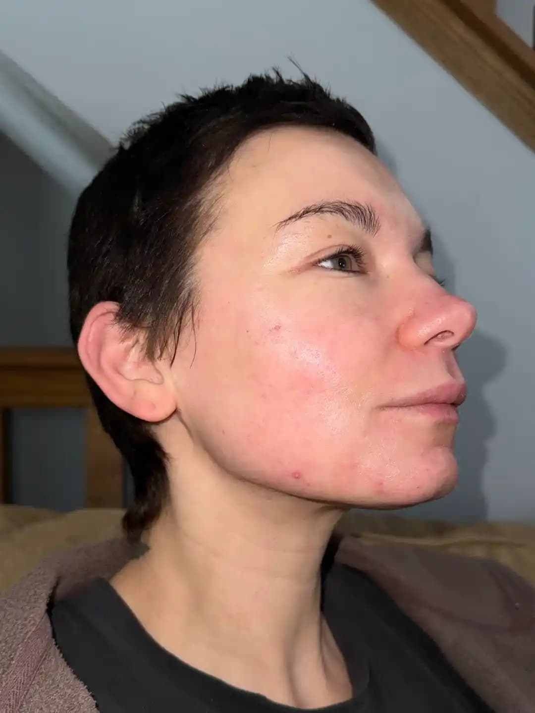 Akne Sonrası Cilt İçin Doğal Görünümlü Fondöten ve Skin Tint Seçenekleri