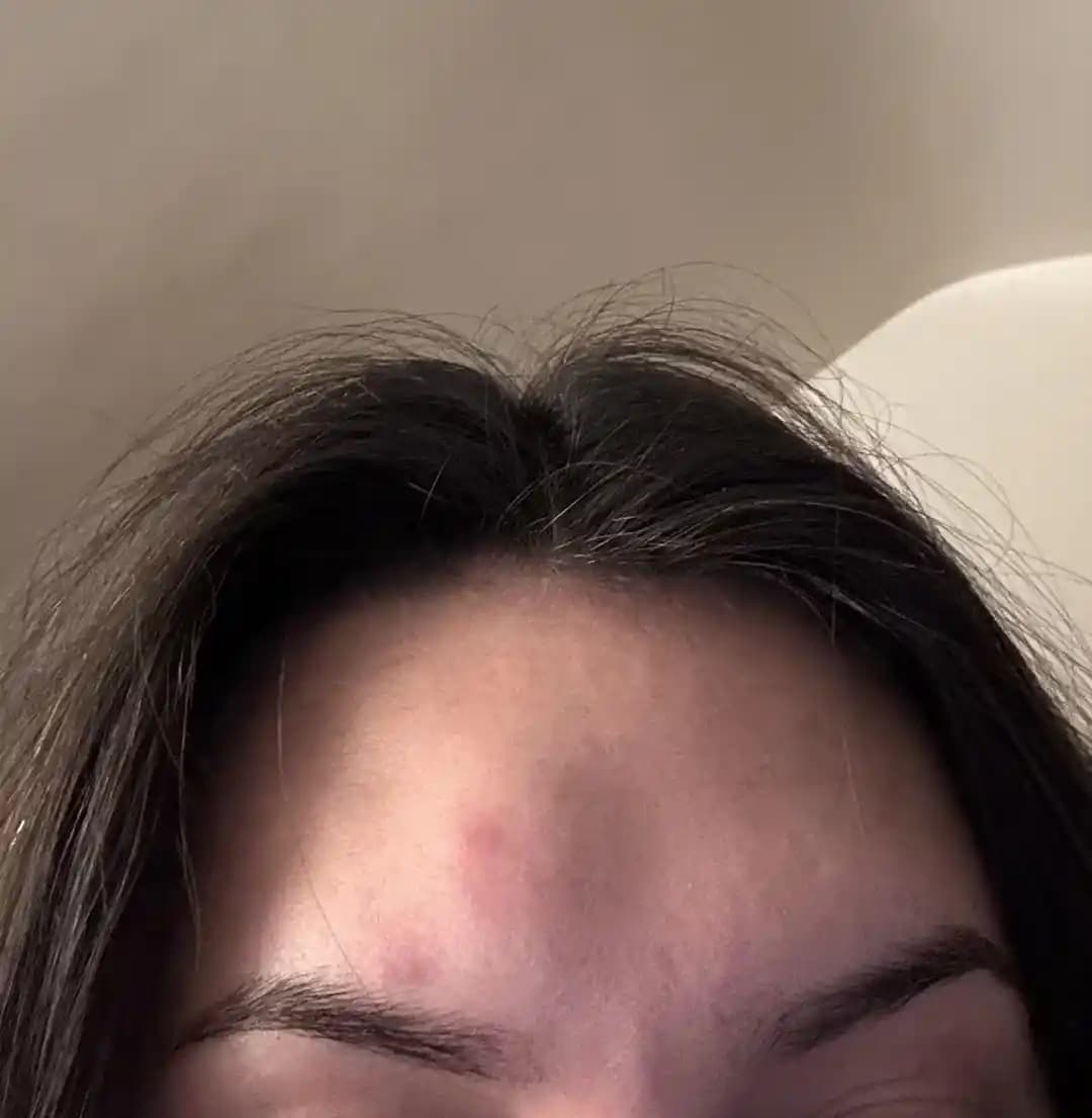 Alın Bölgesinde Şişlik Yapan Sivilceler: Nedenleri, Belirtileri ve Etkili Tedavi Yöntemleri