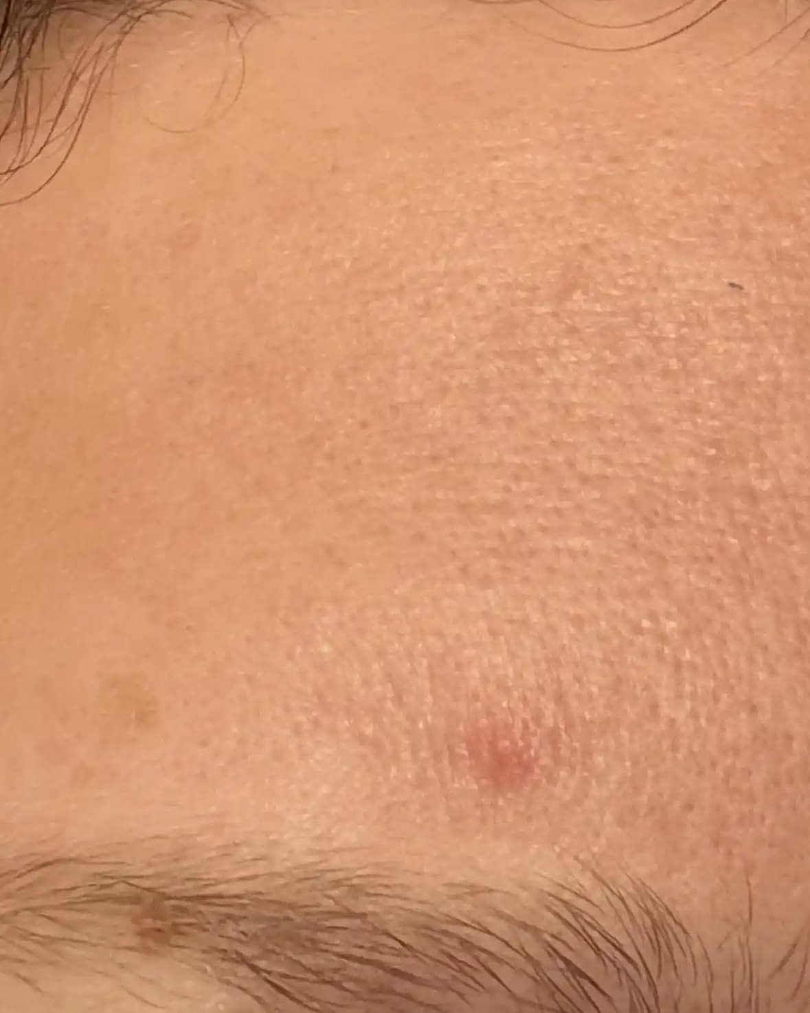 Bazal Hücre Karsinomu: Erken Tanı, Belirtiler ve Korunma Yöntemleri Üzerine Detaylı İnceleme