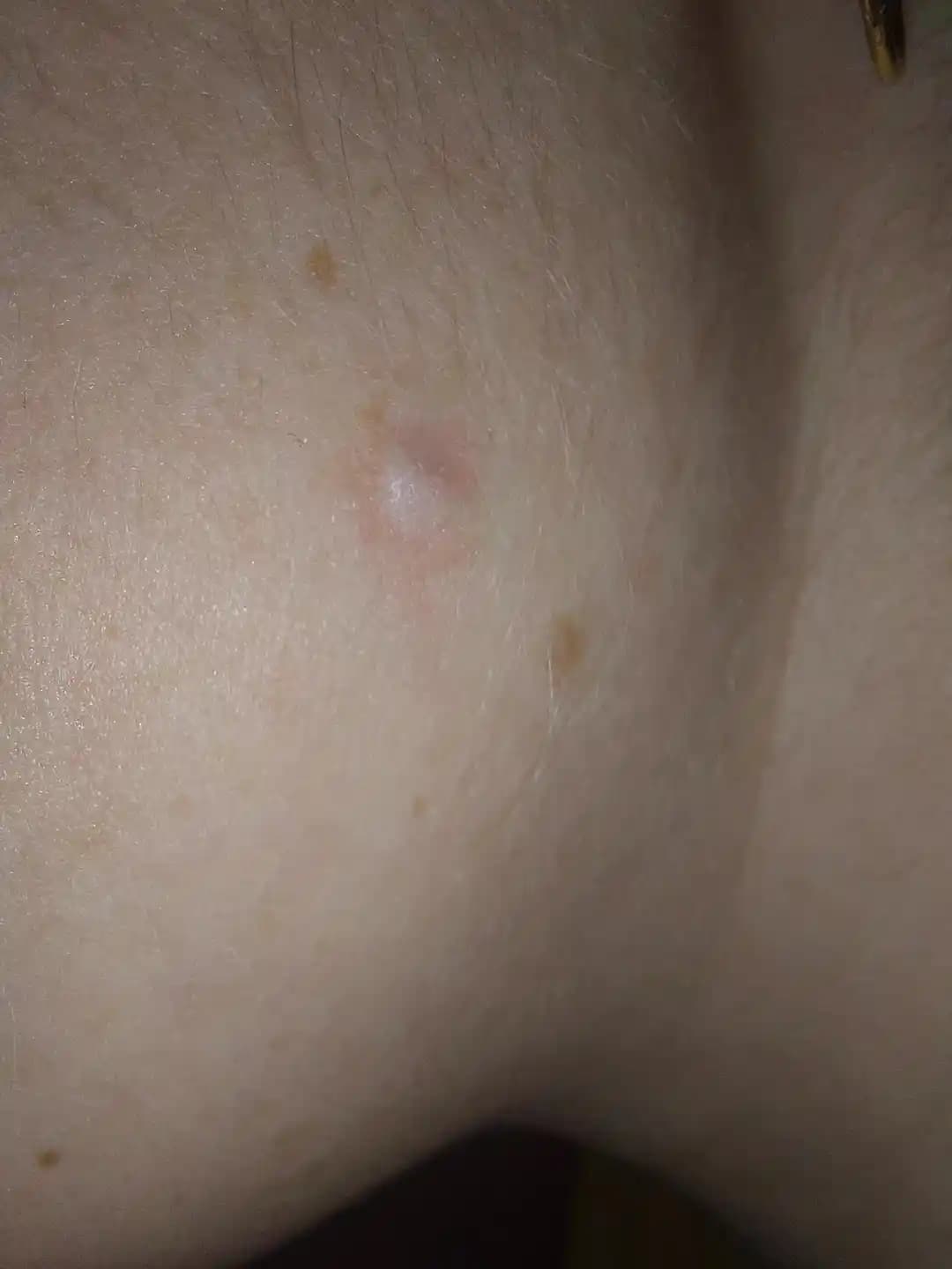 Ben Alımı Sonrası İzler ve Tedavi Yöntemlerinin Etkinliği Üzerine İnceleme