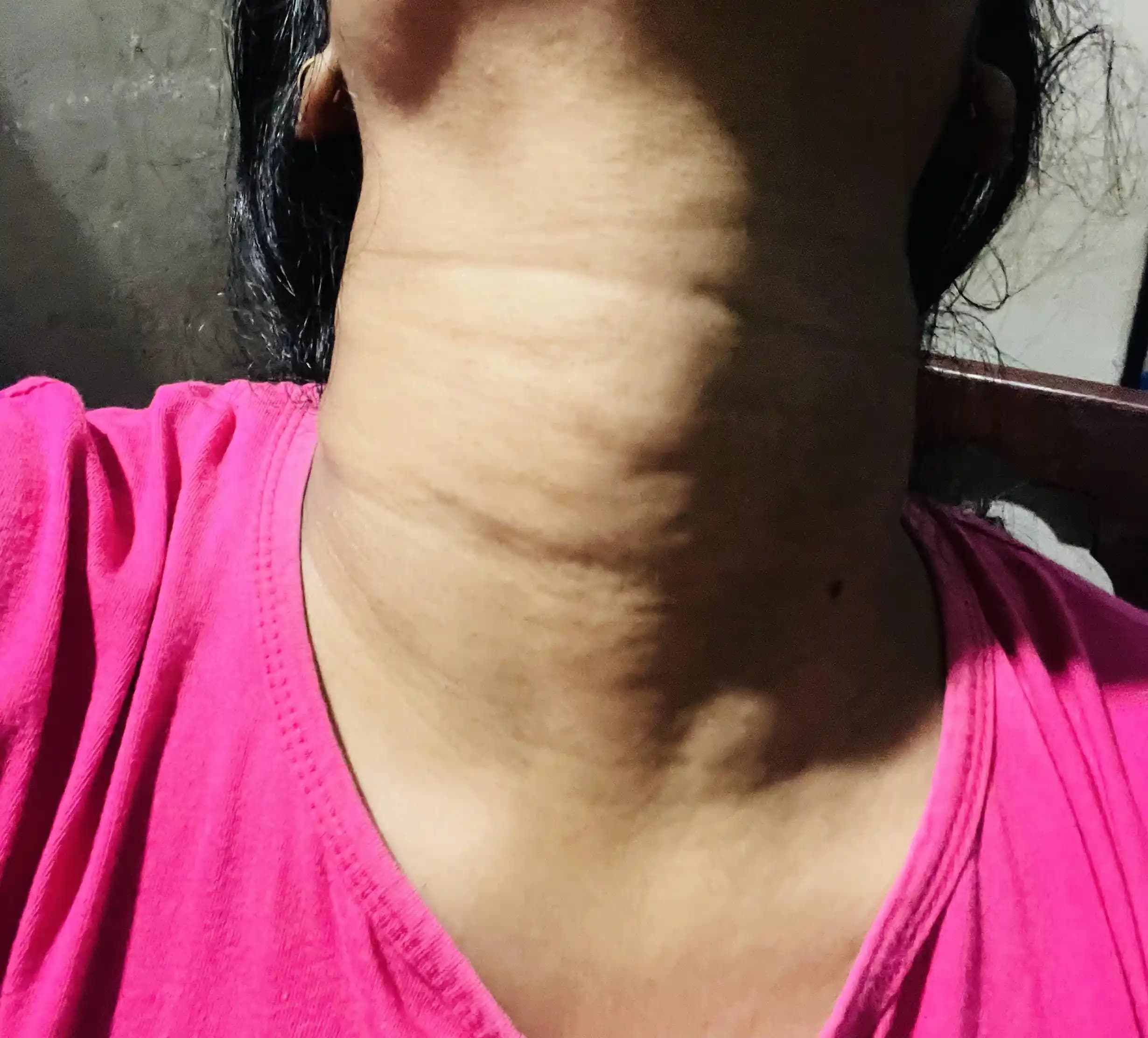 Boyun Çizgileri: Nedenleri, Tedavi Yöntemleri ve Etkili Bakım Önerileri