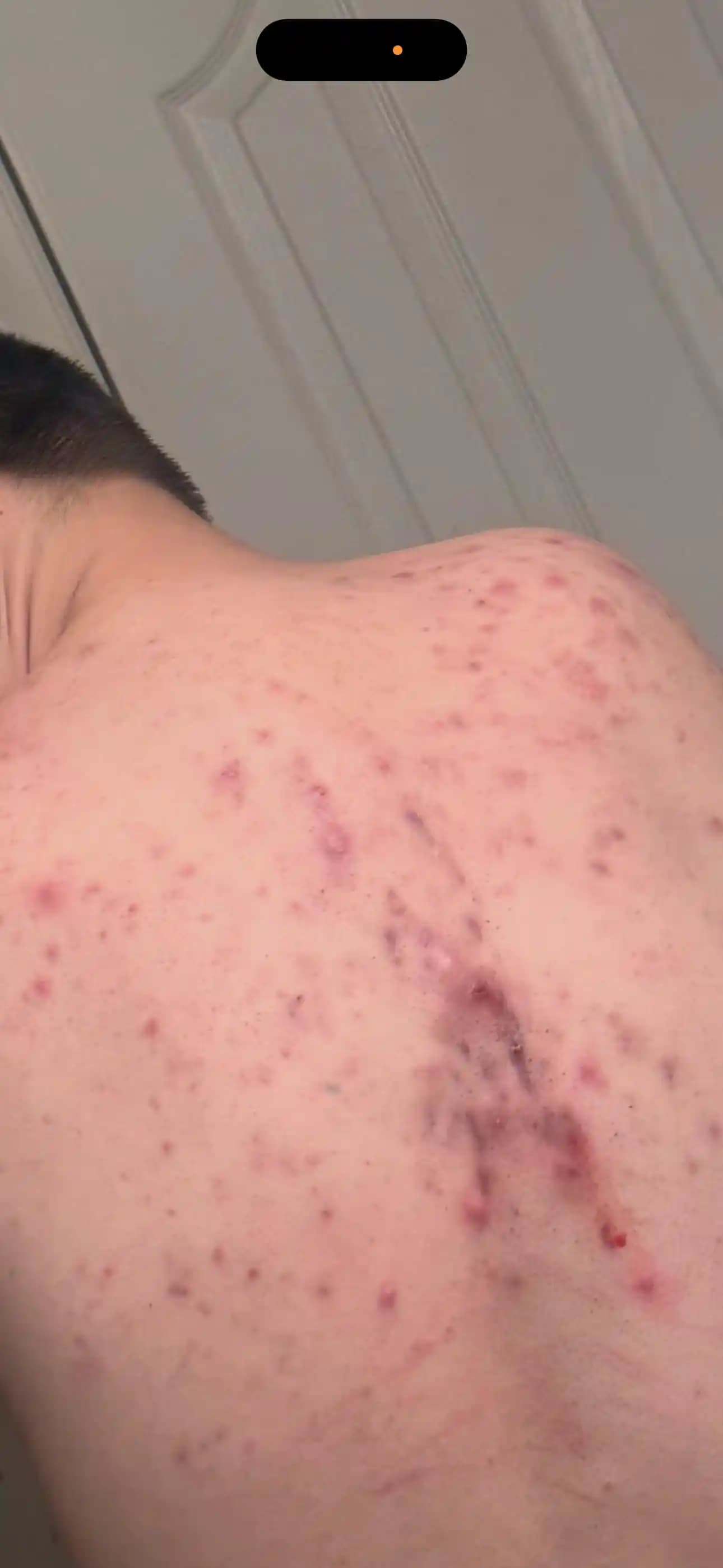 Derin ve Kistik Sırt Aknesi Tedavisi: Dermatolojik Yaklaşımlar ve Yaşam Tarzı Önerileri