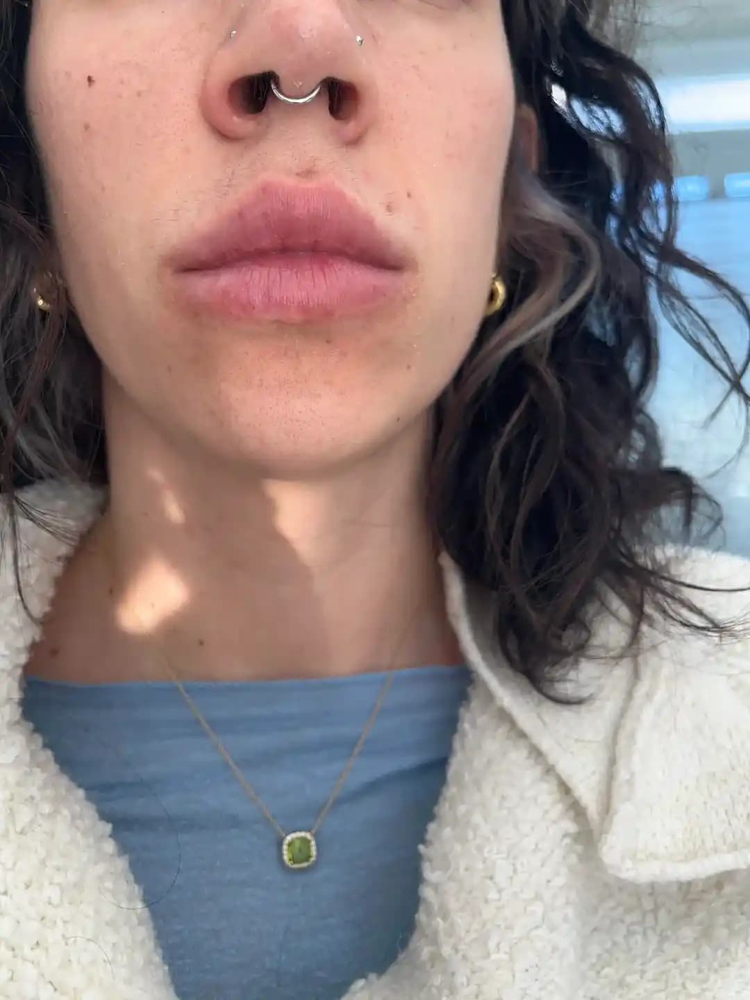 Dudak Dolgusu Sonrası Görünüm ve Düzeltme Yöntemleri: Doğal Dudakların Önemi