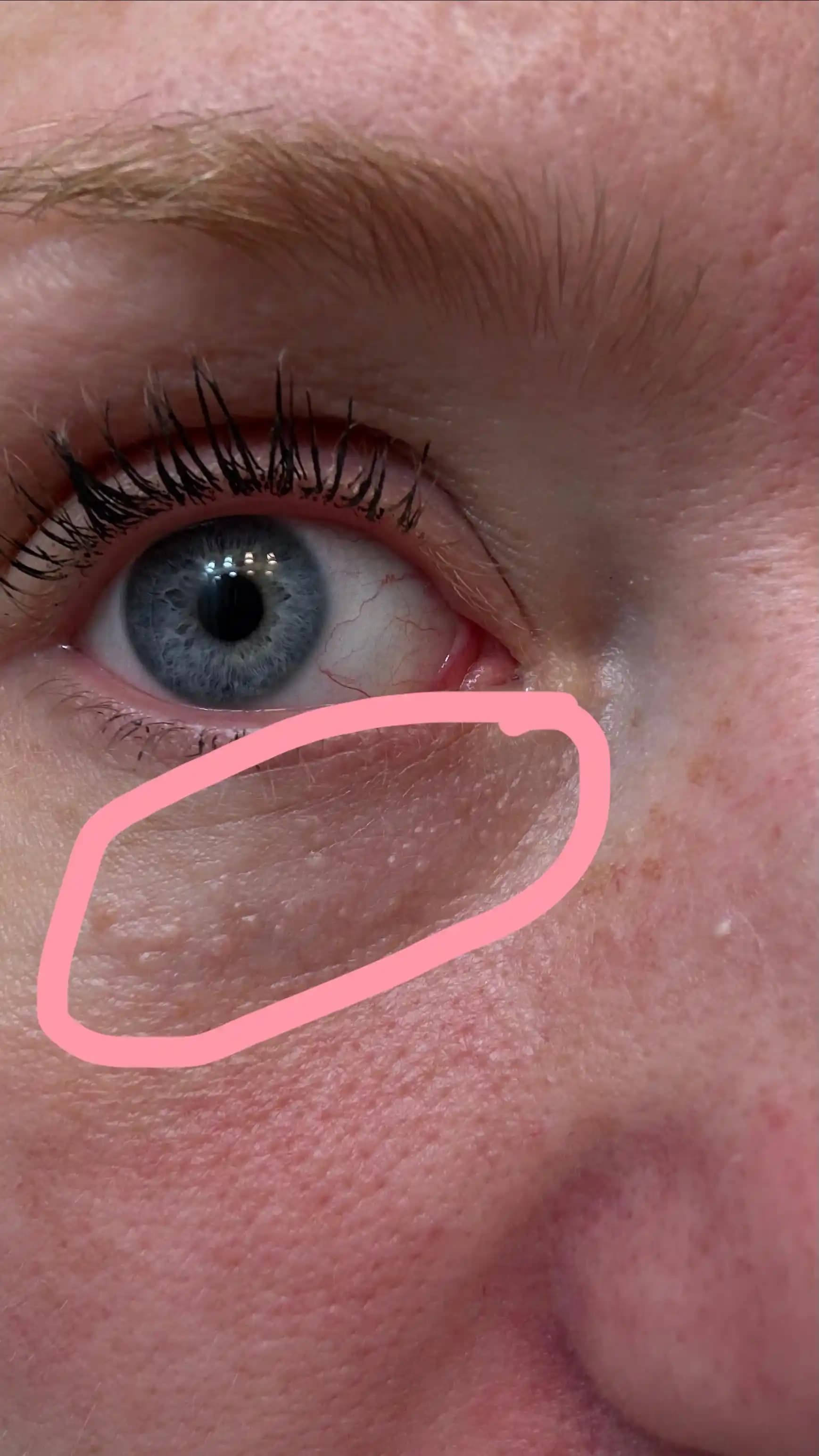 Göz Altı Tümsekleri: Nedenleri, Tanısı ve Etkili Tedavi Yöntemleri Hakkında Bilgi