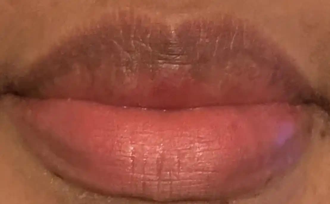 İki Tonlu Dudaklar: Doğal Pigmentasyon ve Estetik Yaklaşımların İncelenmesi