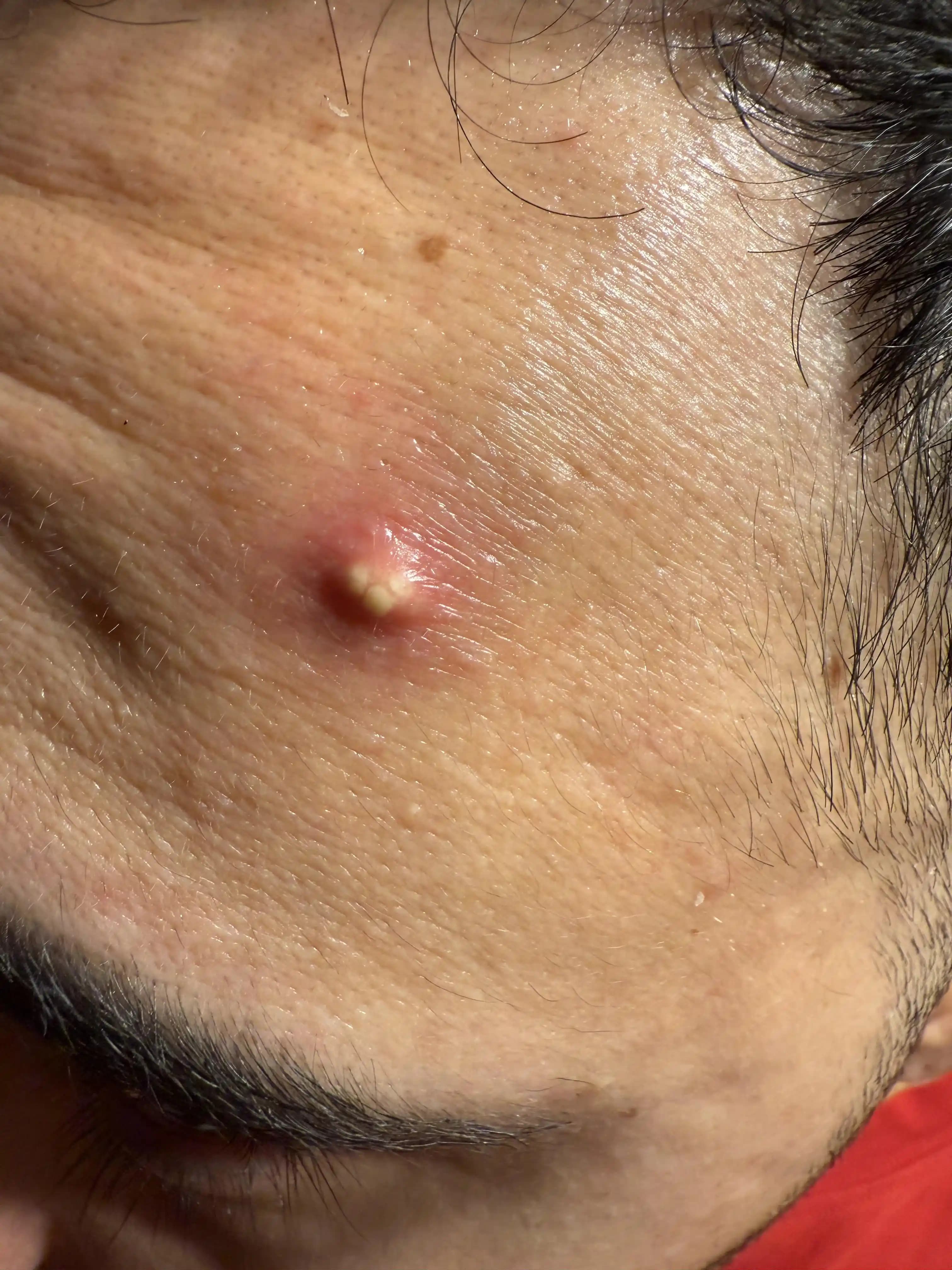 İnatçı Kistik Akne ve Aşırı Yağlı Cilt Tedavisinde Etkili Yöntemler ve Deneyimler