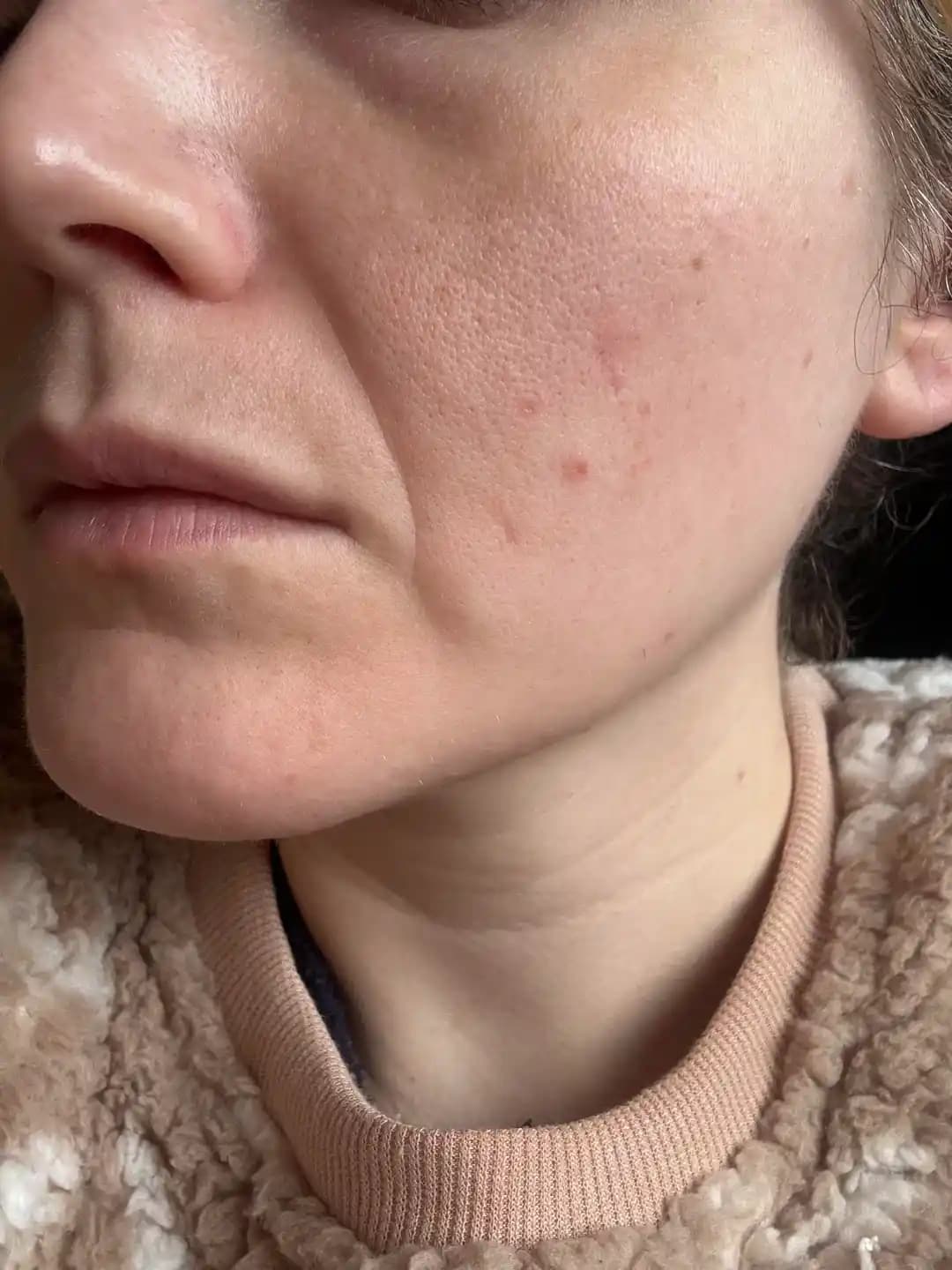 Nazolabial ve Marionette Çizgileri: Cilt Yaşlanması ve Etkili Bakım Yöntemleri