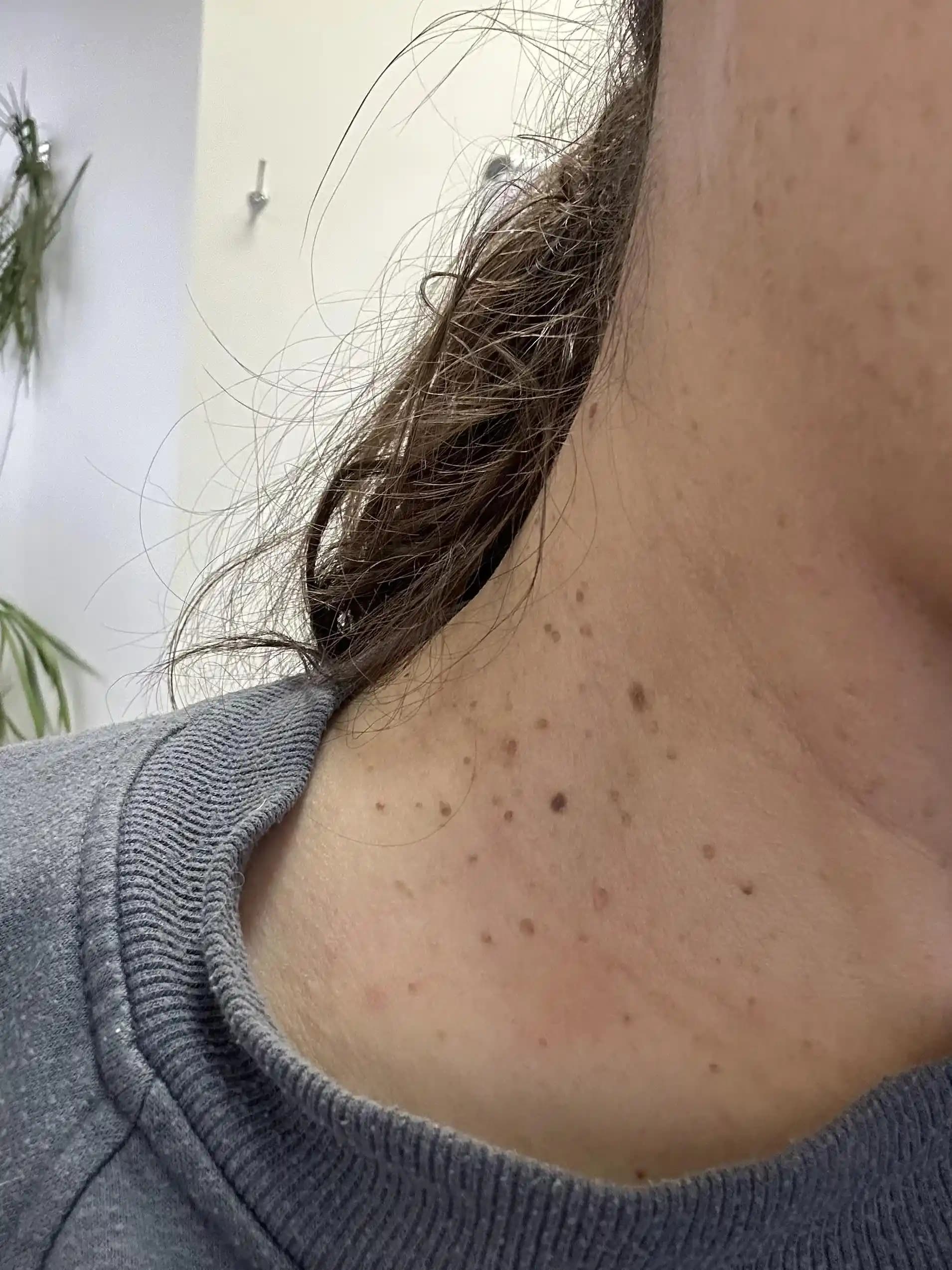 Seboreik Keratoz Nedenleri, Belirtileri ve Güncel Tedavi Yöntemleri