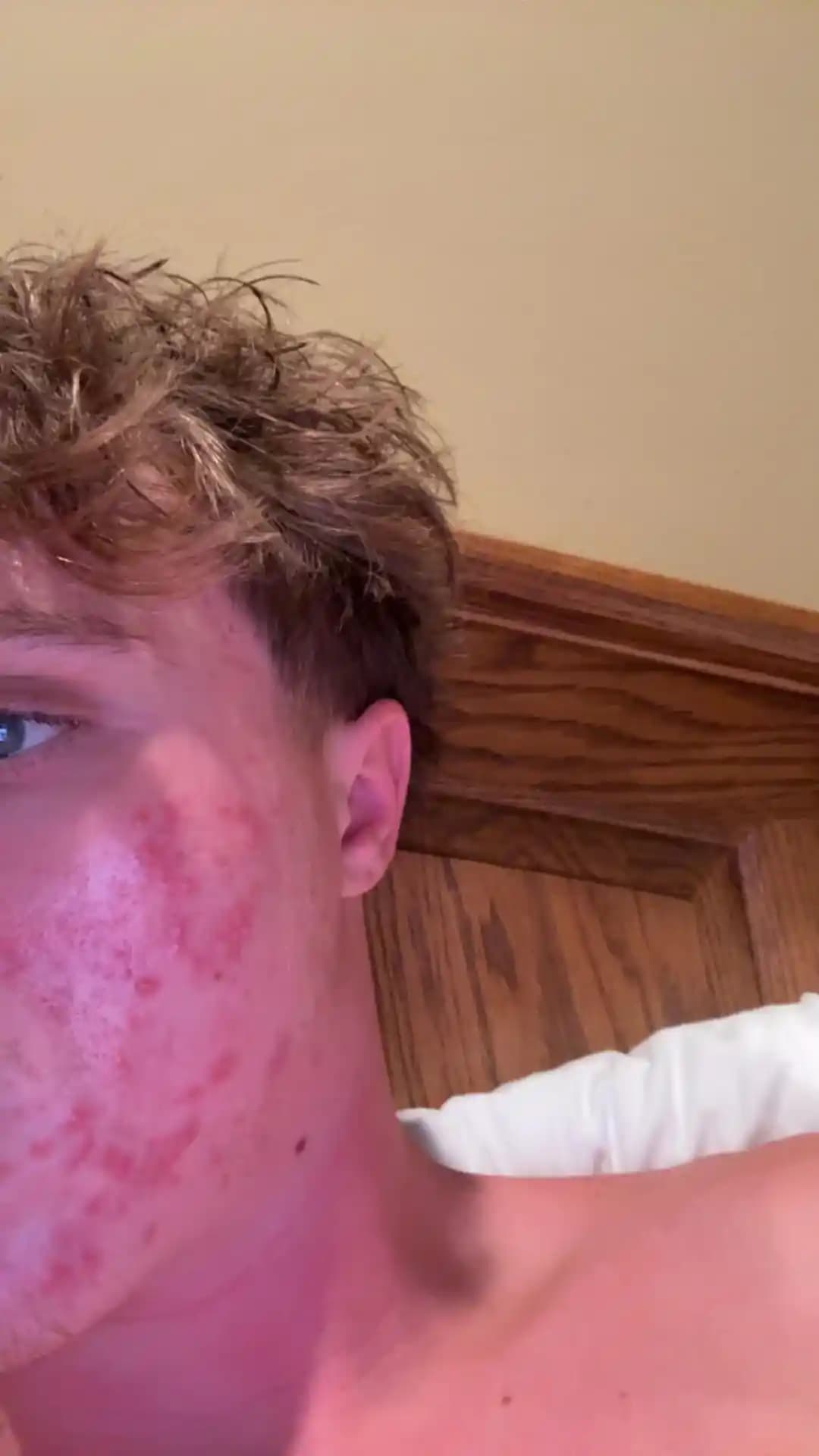 Şiddetli Akne Tedavisinde Dermatolojik Yaklaşımlar ve Etkili Cilt Bakımı Yöntemleri