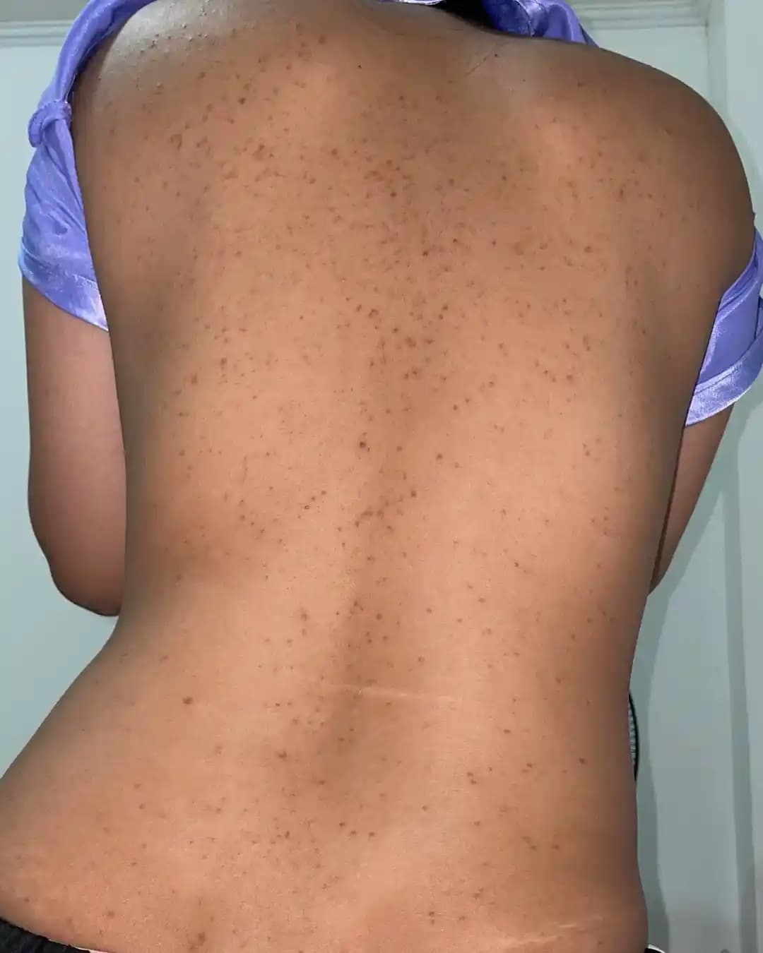 Sırt Aknesi ve Koyu Lekelerle Mücadelede Etkili Tedavi ve Bakım Yöntemleri