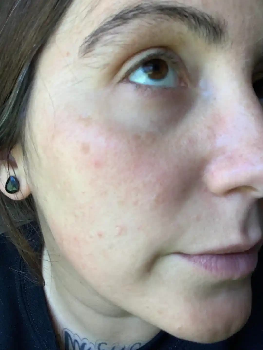 Ultra Clear Lazer Tedavisi: Güneş Lekeleri ve Dermal İzlerde İyileşme Süreci ve Sonuçları